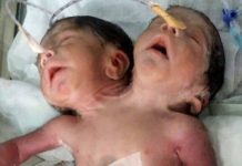 Hôpital de Kankan : une femme accouche d’un bébé avec deux têtes, deux bouches, quatre yeux et quatre oreilles