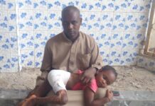 SOS : le cri de détresse d’un père dont la fille a été victime d’une brûlure il y a 3 ans