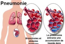 La pneumonie : Une maladie méconnue mais mortelle