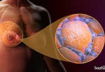 Cancer du sein: comprendre cette maladie pernicieuse et prendre des dispositions
