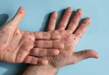 Mpox au Nigeria : 39 cas confirmés en 2024, l’épidémie sous surveillance