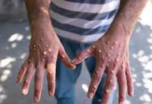 Côte d’Ivoire : 28 cas de variole de singe confirmés, un décès signalé