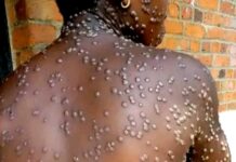 Guinée : Premier cas confirmé de Mpox