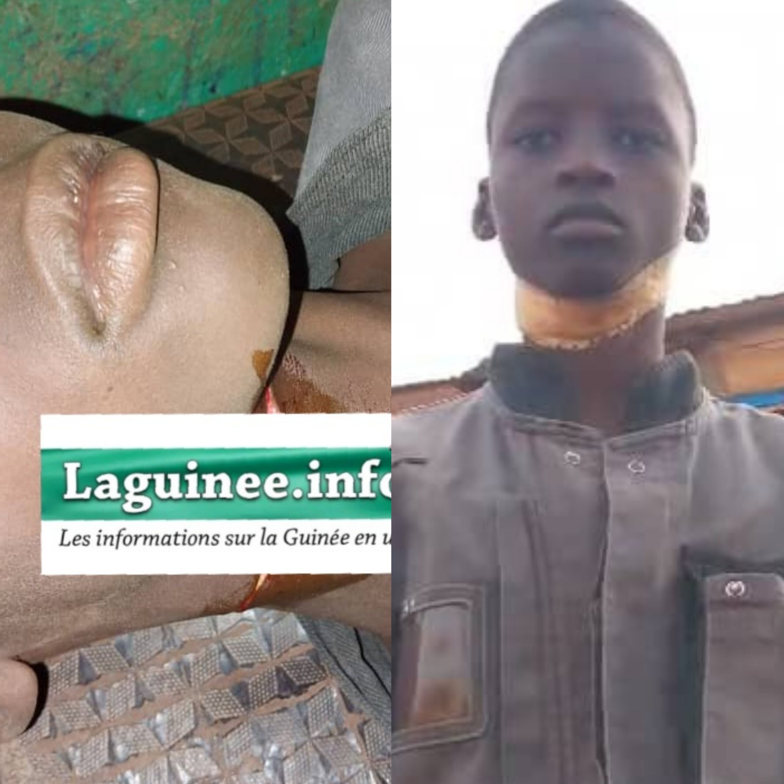 Bouré-Boukaria: le petit Aboubacar Kourouma échappe de justesse à la mort après une agression