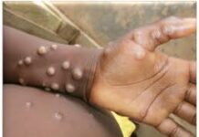 Afrique de l’Ouest: La Sierra Leone déclare l’état d’urgence sanitaire face au Mpox